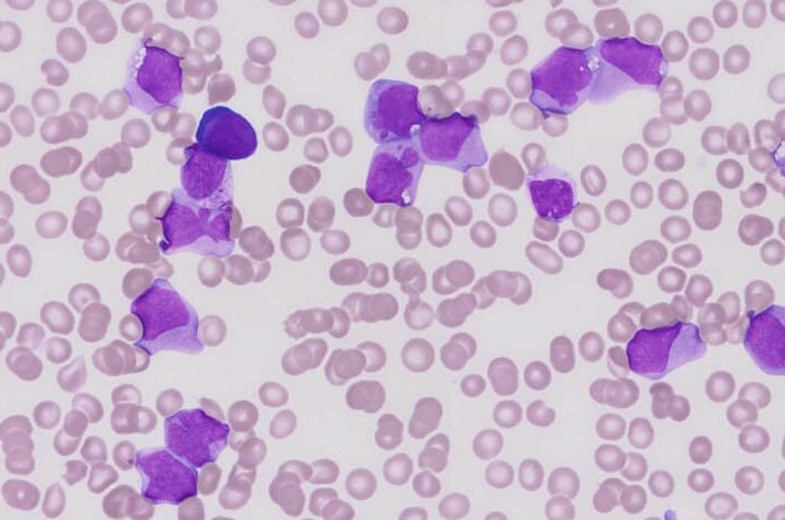 Como Identificar Leucemia No Hemograma 6491