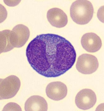 Blasto leucemia promielocitica