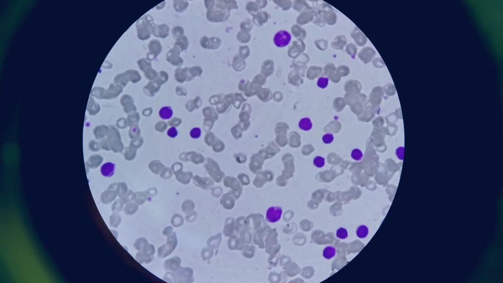 Imagem microscopica de uma lamina com leucemia