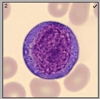 Linfócito plasmocitoide