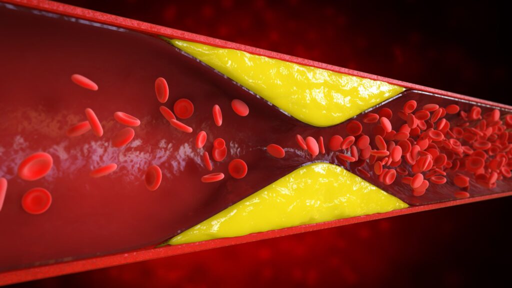 Veia com gordura nas paredes dos vasos causando o sangue grosso
