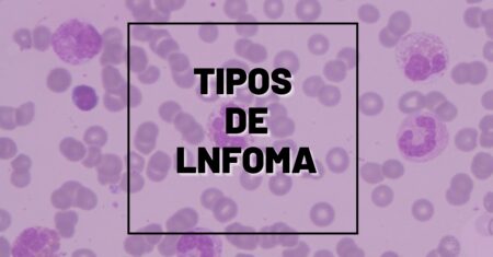 Quais são os Tipos de Linfoma: Hodgkin e Não Hodgkin – Sintomas, Diagnóstico Laboratorial e Tratamento